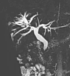 图1 MRCP：肝右叶胆管结石，胆总管结石